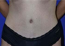 Tummy Tuck Before & After