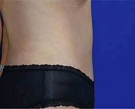 Tummy Tuck Before & After