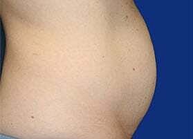 Tummy Tuck Before & After
