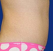 Tummy Tuck Before & After