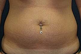 Tummy Tuck Before & After