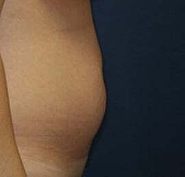 Tummy Tuck Before & After