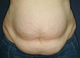 Tummy Tuck Before & After