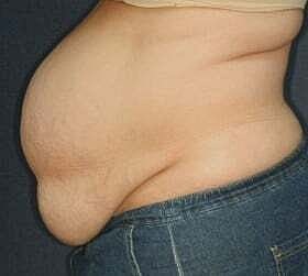 Tummy Tuck Before & After