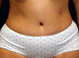 Tummy Tuck Before & After