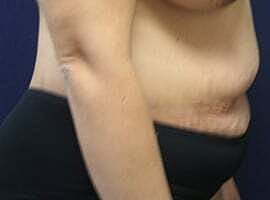 Tummy Tuck Before & After