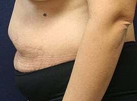 Tummy Tuck Before & After