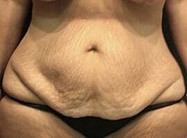 Tummy Tuck Before & After