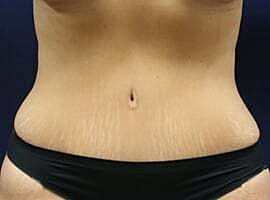 Tummy Tuck Before & After