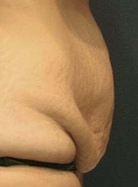 Tummy Tuck Before & After