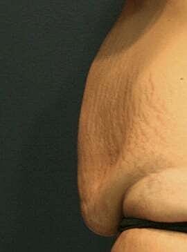 Tummy Tuck Before & After