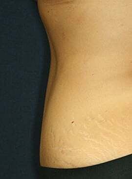 Tummy Tuck Before & After