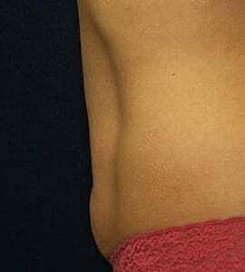 Tummy Tuck Before & After