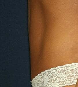 Tummy Tuck Before & After