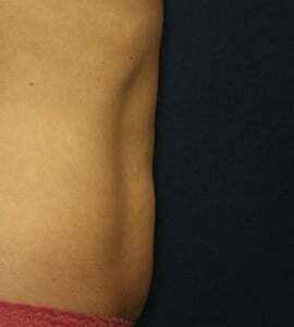 Tummy Tuck Before & After
