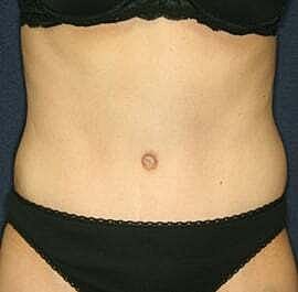 Tummy Tuck Before & After