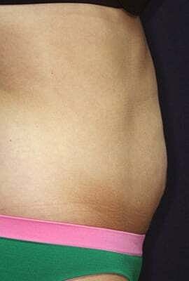 Tummy Tuck Before & After
