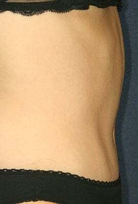 Tummy Tuck Before & After