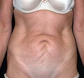 Tummy Tuck Before & After