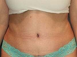 Tummy Tuck Before & After