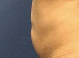 Tummy Tuck Before & After