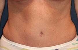 Tummy Tuck Before & After