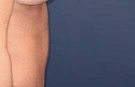 Tummy Tuck Before & After