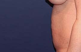 Tummy Tuck Before & After