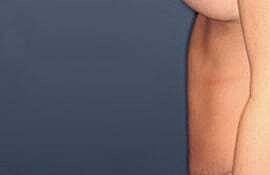 Tummy Tuck Before & After
