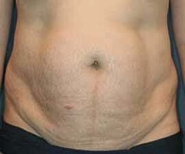 Tummy Tuck Before & After
