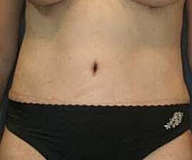 Tummy Tuck Before & After