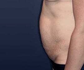 Tummy Tuck Before & After