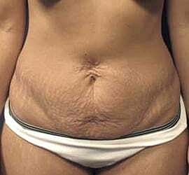 Tummy Tuck Before & After