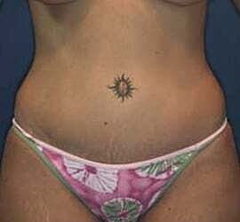 Tummy Tuck Before & After