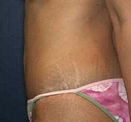 Tummy Tuck Before & After
