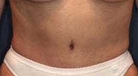 Tummy Tuck Before & After