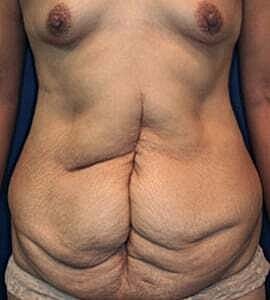 Tummy Tuck Before & After