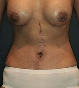 Tummy Tuck Before & After