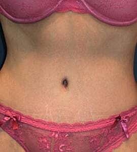 Tummy Tuck Before & After