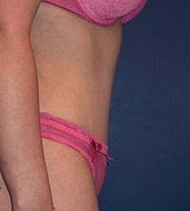 Tummy Tuck Before & After