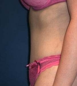Tummy Tuck Before & After