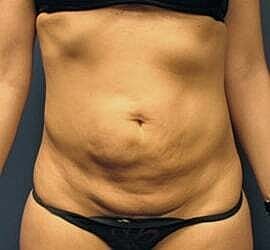 Tummy Tuck Before & After