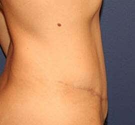 Tummy Tuck Before & After