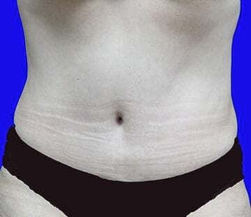 Tummy Tuck Before & After