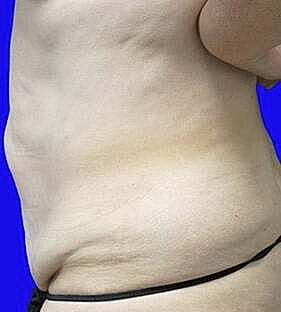 Tummy Tuck Before & After