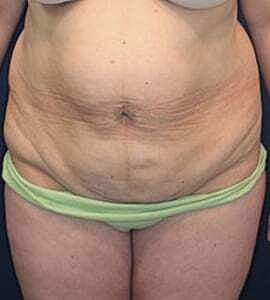 Tummy Tuck Before & After