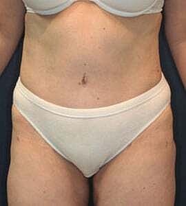 Tummy Tuck Before & After