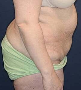 Tummy Tuck Before & After