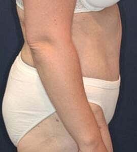 Tummy Tuck Before & After