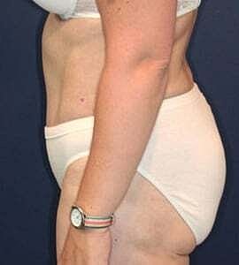 Tummy Tuck Before & After